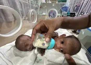 bayi kembar siam